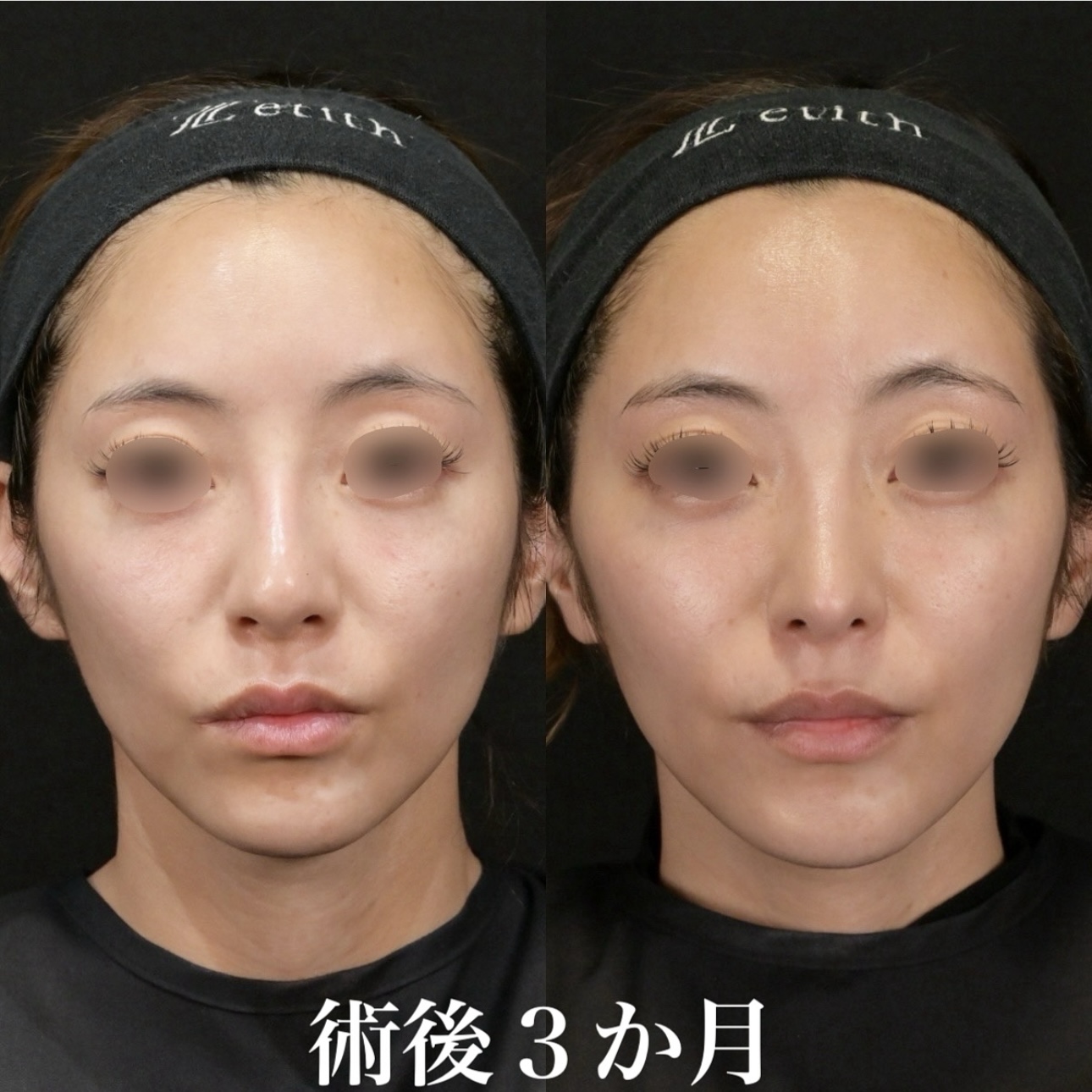 鉄医師による鼻整形の施術前／施術後3ヶ月
