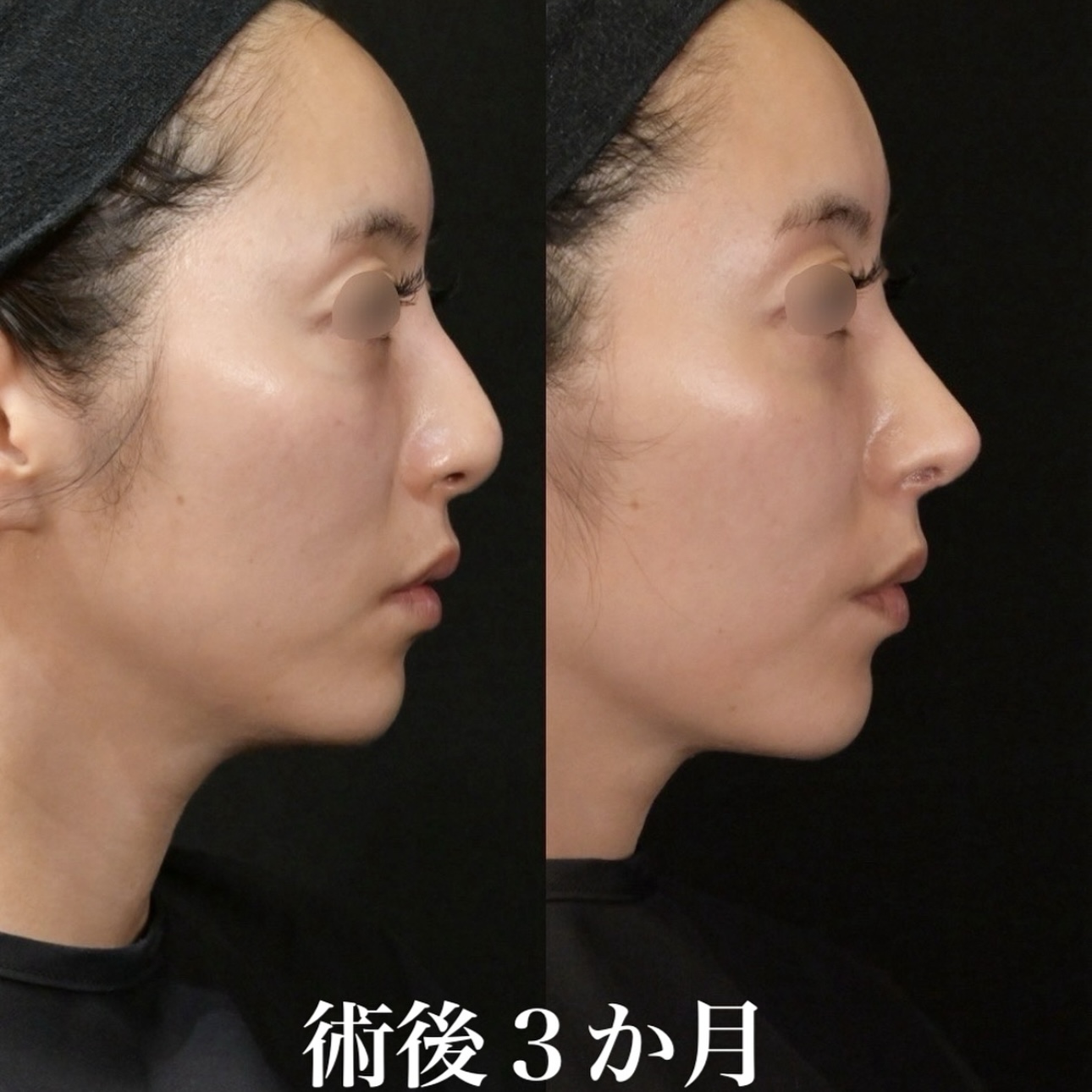 鉄医師による鼻整形の施術前／施術後3ヶ月 施術後 