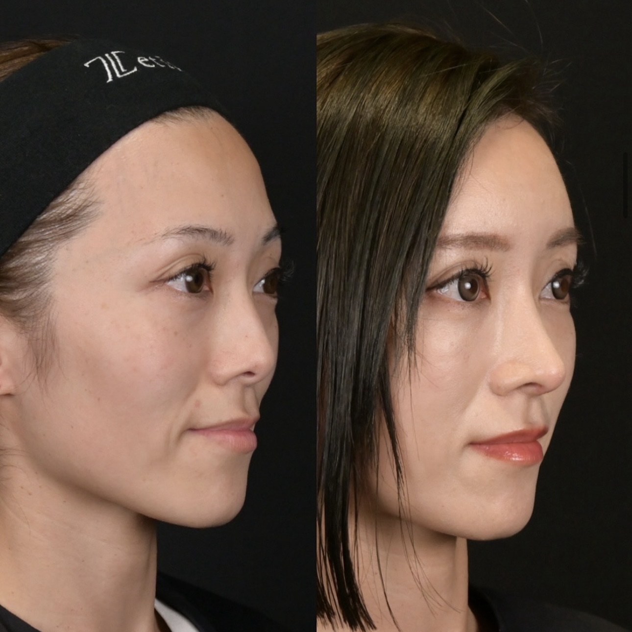 鉄医師による鼻整形の施術前／施術後3ヶ月 Дараа 