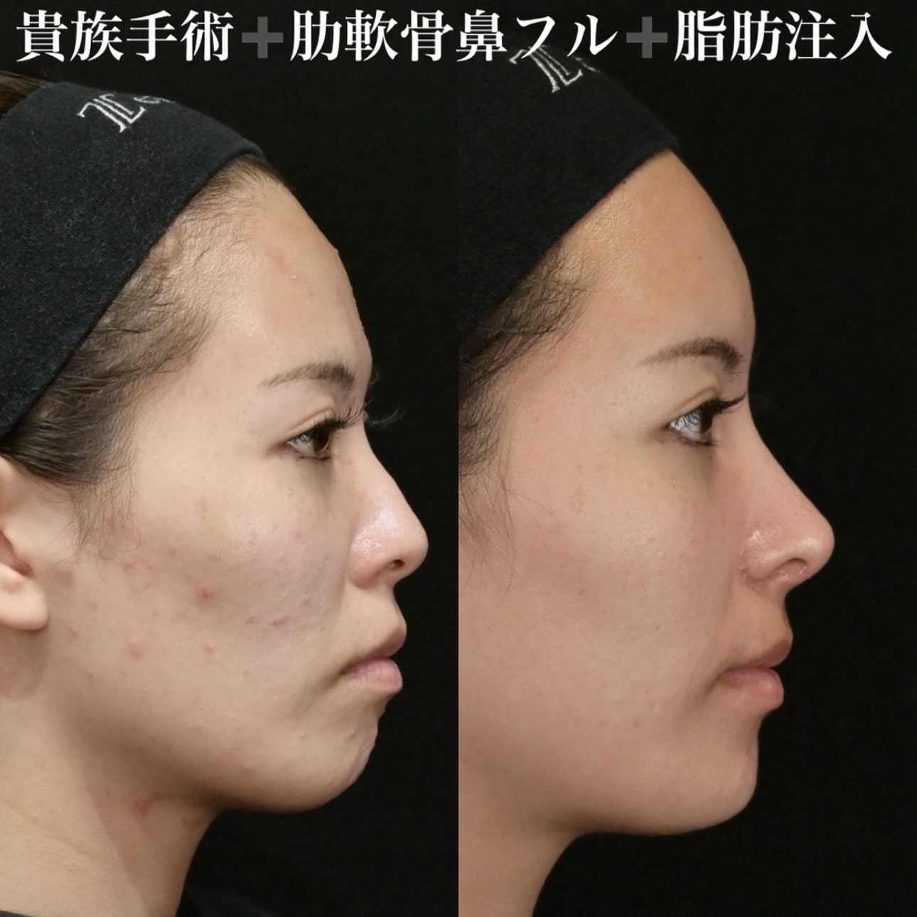鉄医師による鼻整形の施術前／施術後3ヶ月 بعد 