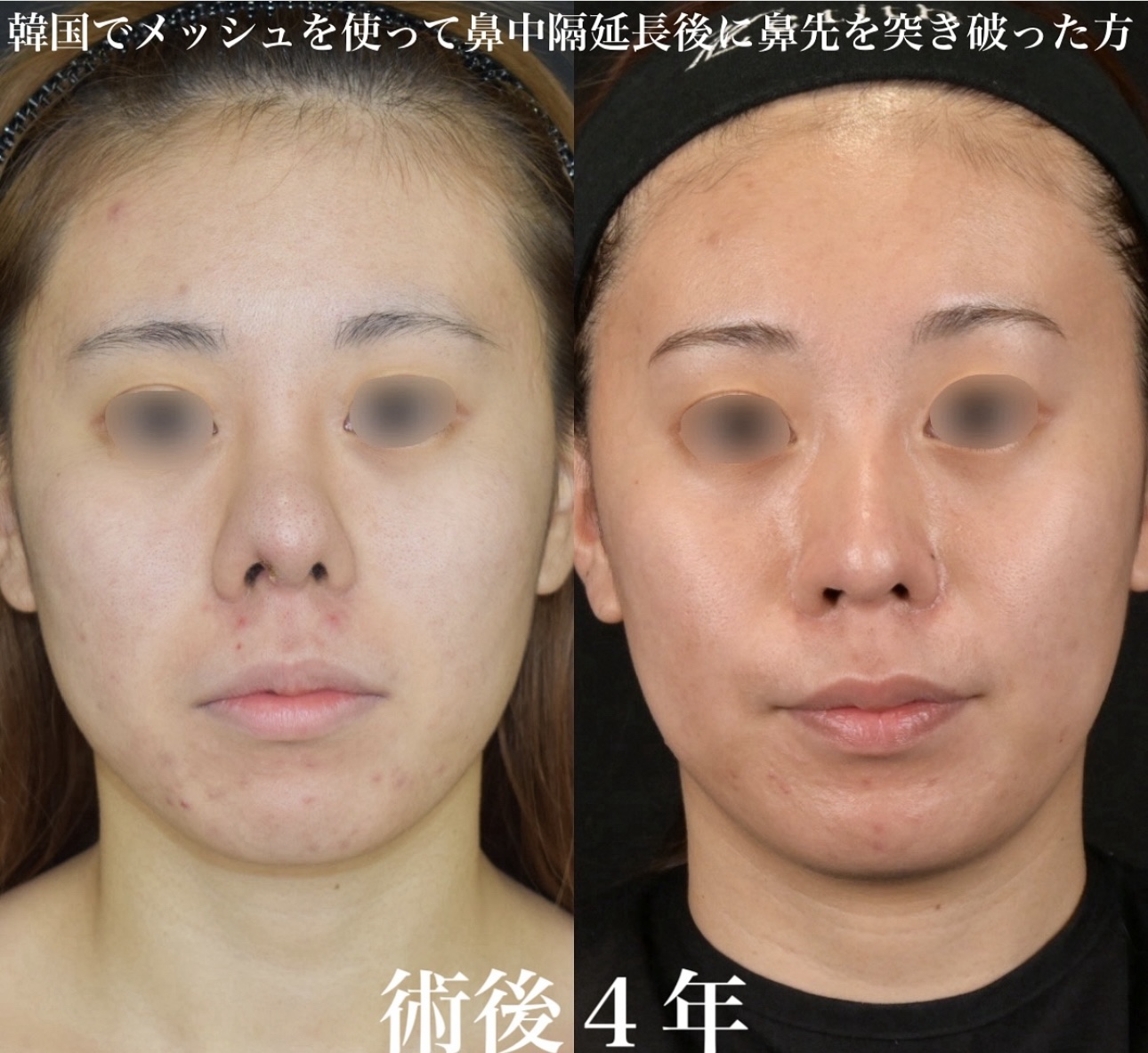 鉄医師による鼻整形の施術前／施術後4年