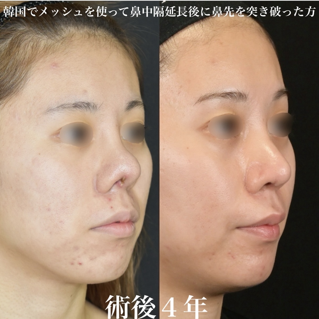鉄医師による鼻整形の施術前／施術後4年 术后 
