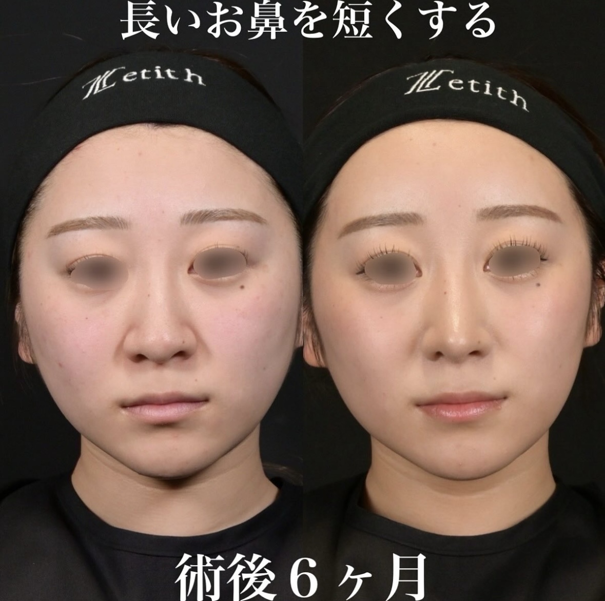 鉄医師による鼻整形の施術前／施術後6ヶ月