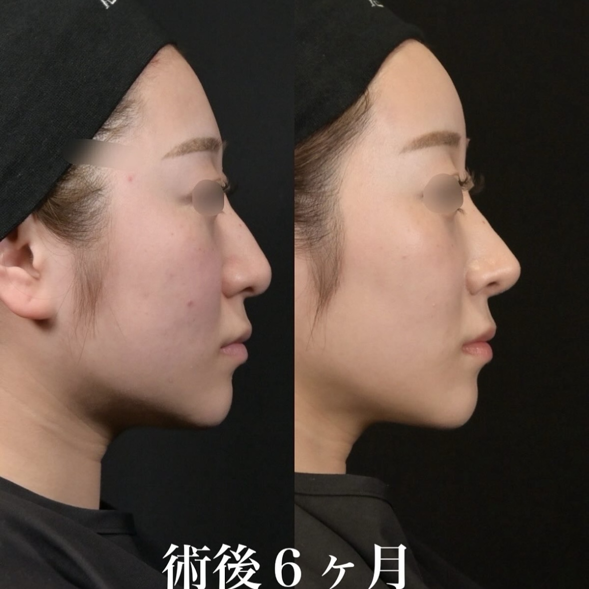 鉄医師による鼻整形の施術前／施術後6ヶ月 施術後 