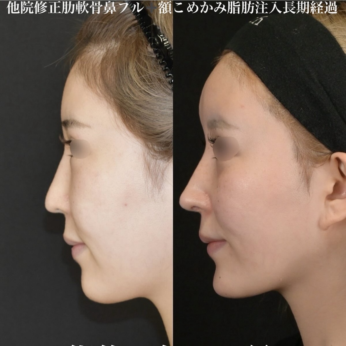 鉄医師による鼻整形の施術前／施術後3年6ヶ月