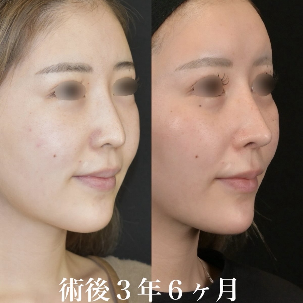 鉄医師による鼻整形の施術前／施術後3年6ヶ月 施術後 