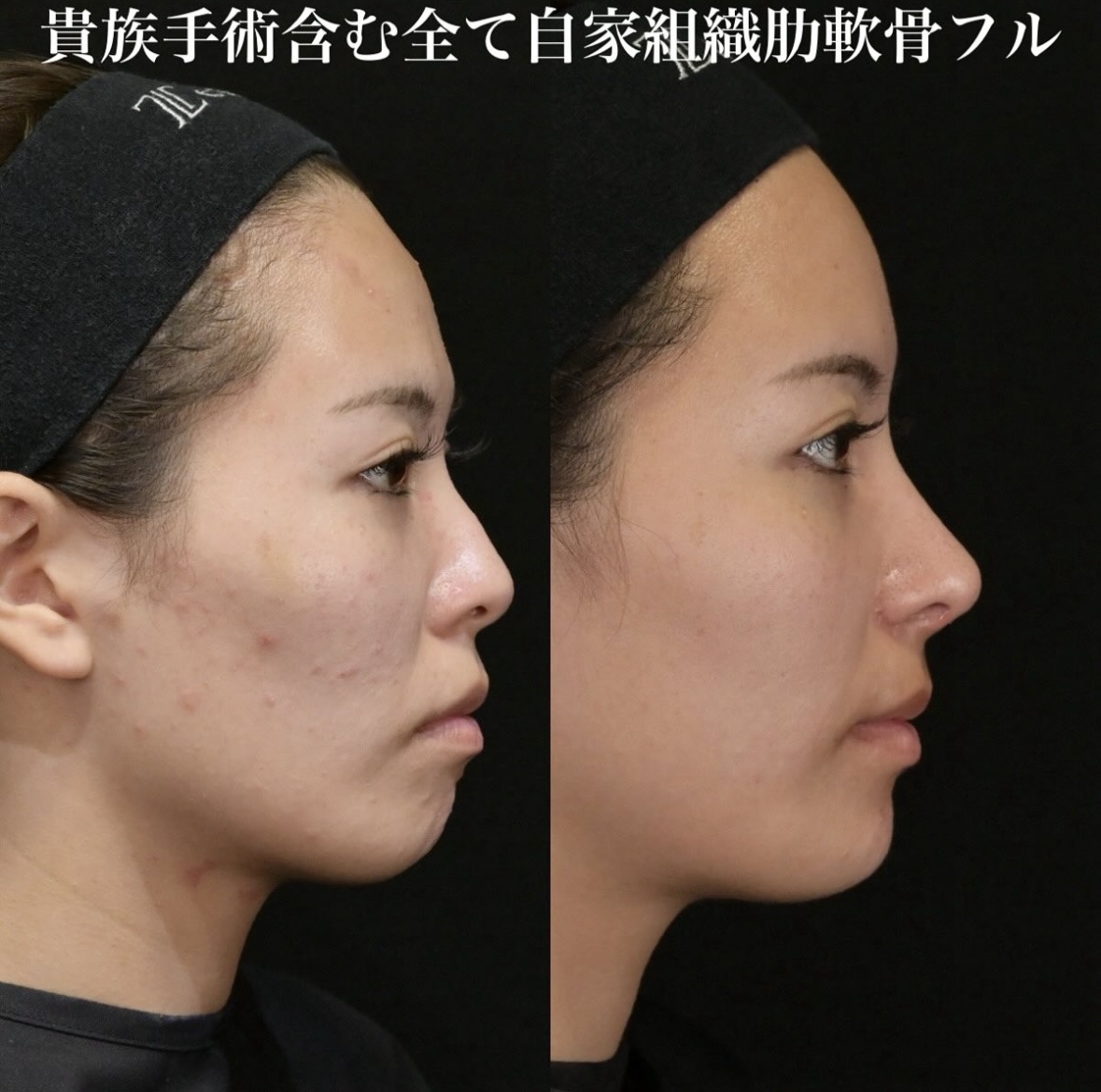 鉄医師による鼻整形の施術前／施術後1ヶ月