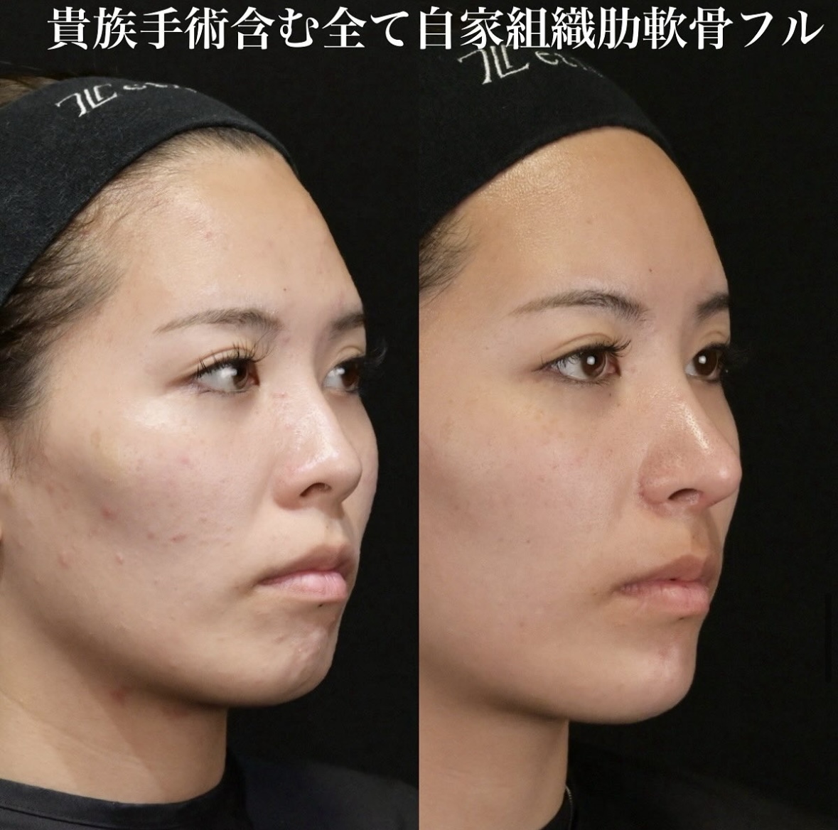 鉄医師による鼻整形の施術前／施術後1ヶ月 Дараа 