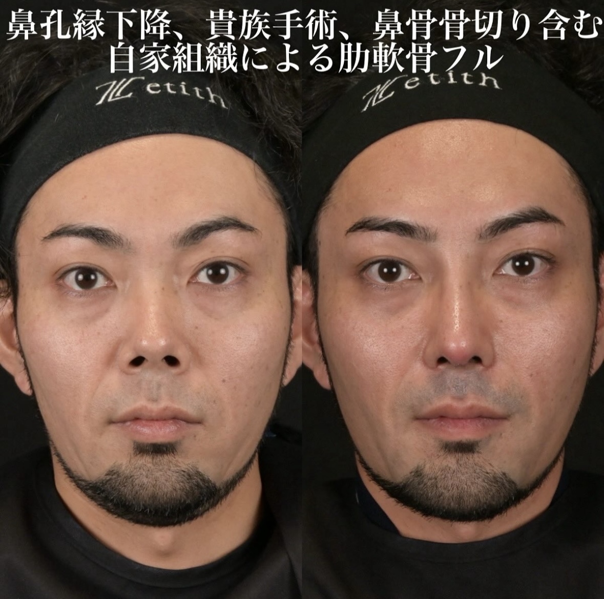 鉄医師による鼻整形の施術前／施術後1ヶ月