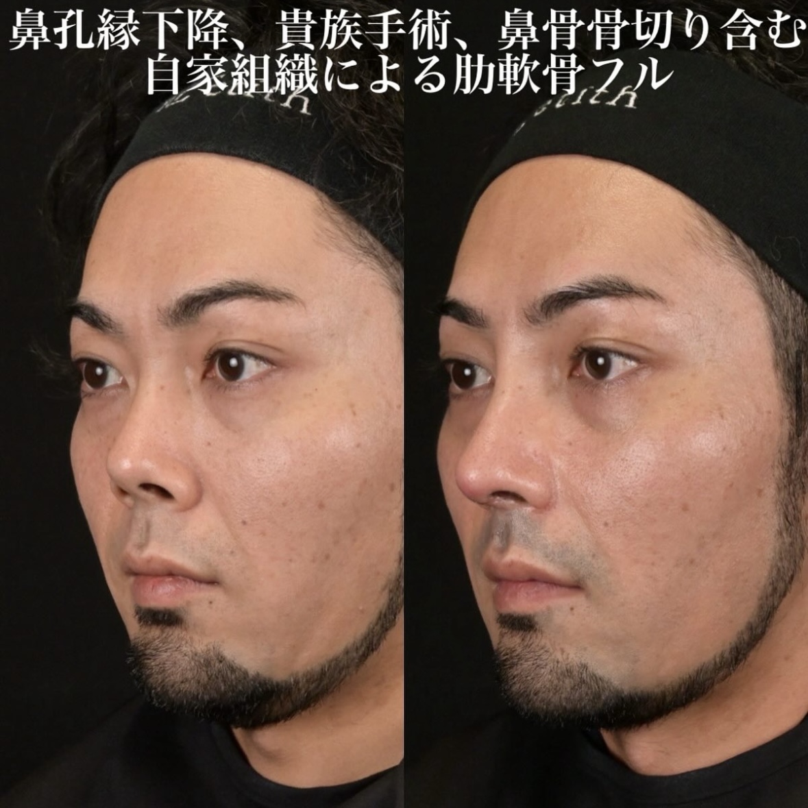 鉄医師による鼻整形の施術前／施術後1ヶ月 施術後 