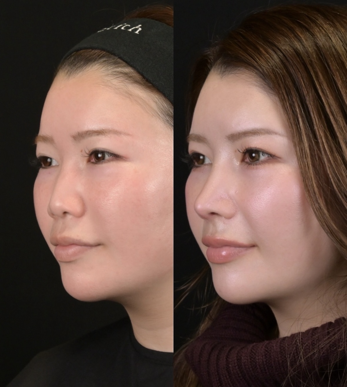 鉄医師による鼻整形の施術前／施術後1ヶ月