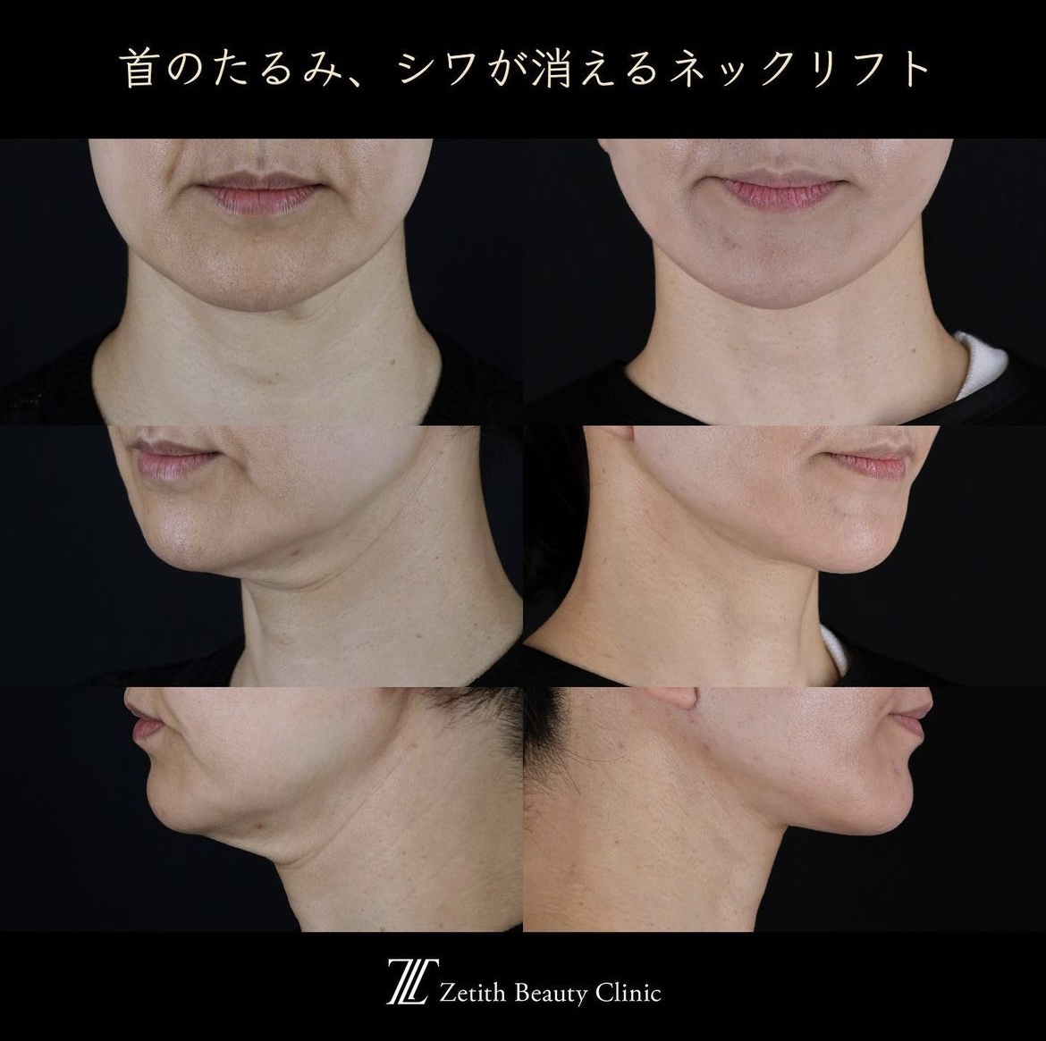 王医師による切開リフトの施術前/施術後7ヶ月