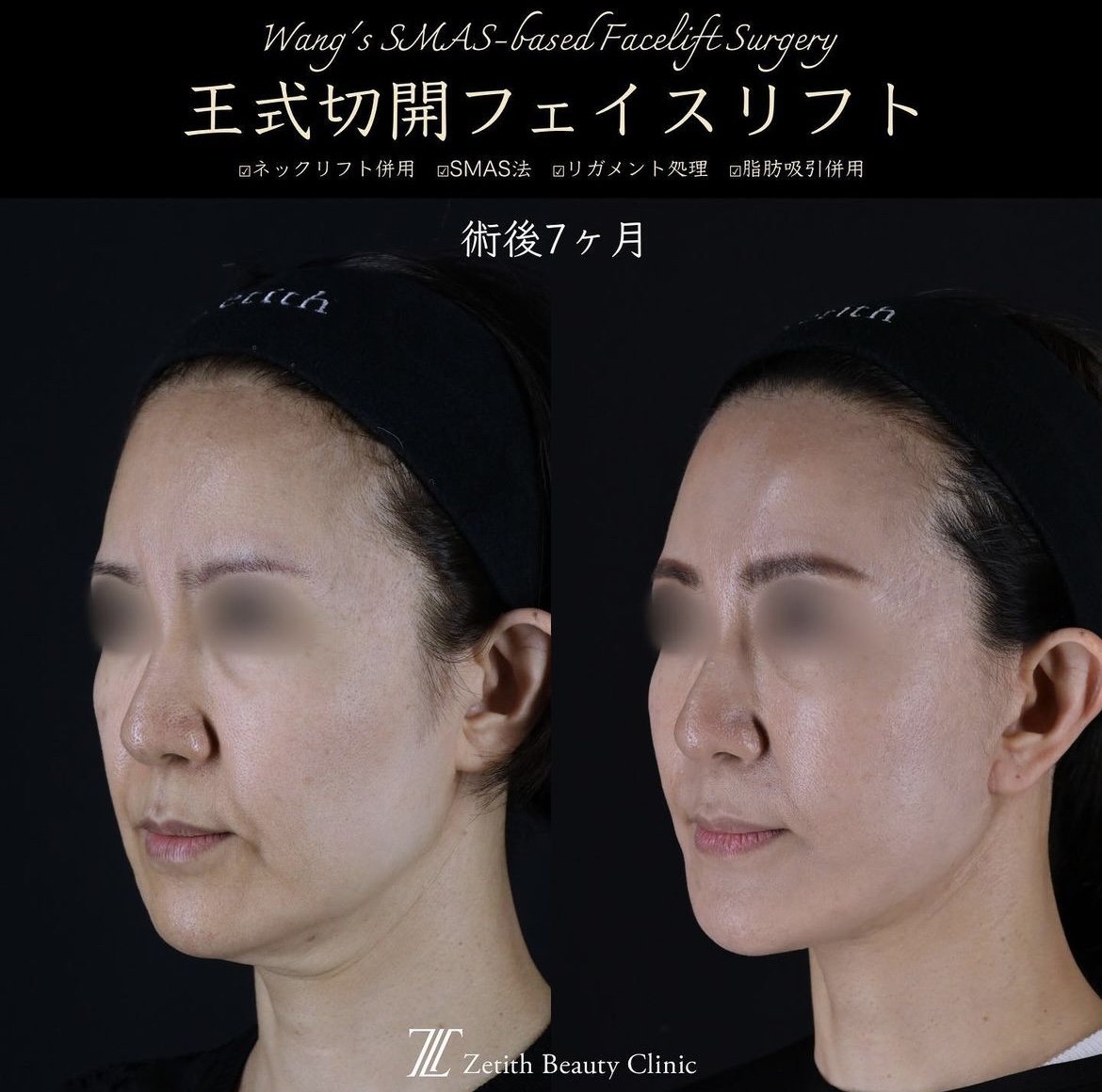 王医師による切開リフトの施術前/施術後7ヶ月 หลัง 