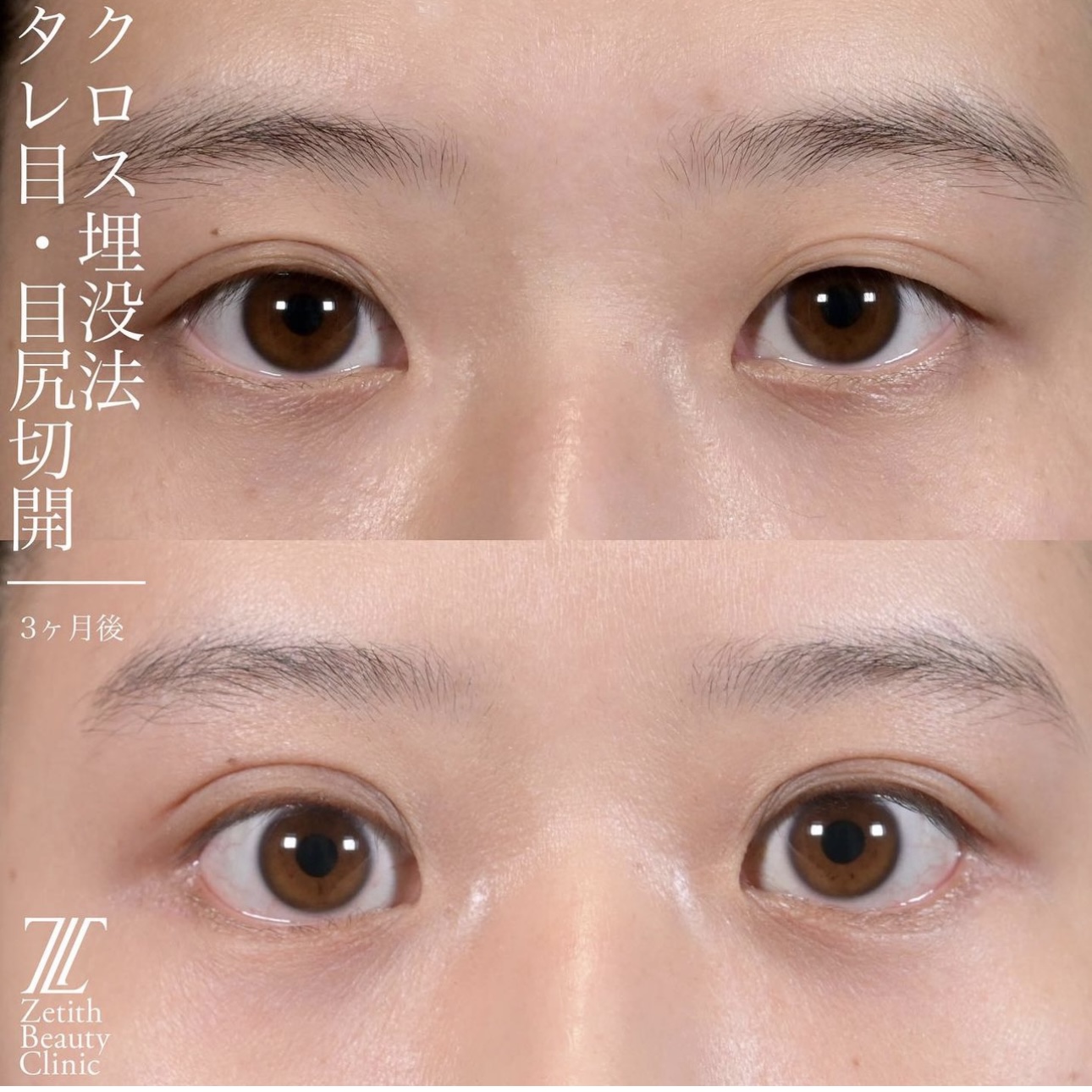 上木原医師による目元整形の施術前／施術後3ヶ月