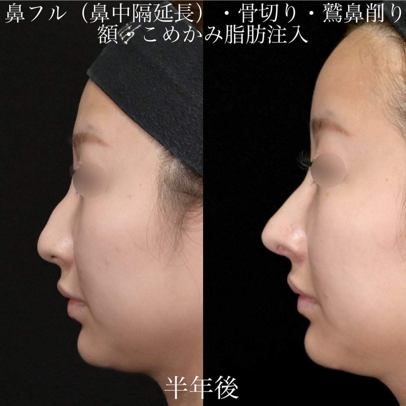 上木原医師による鼻整形の施術前／施術後6ヶ月