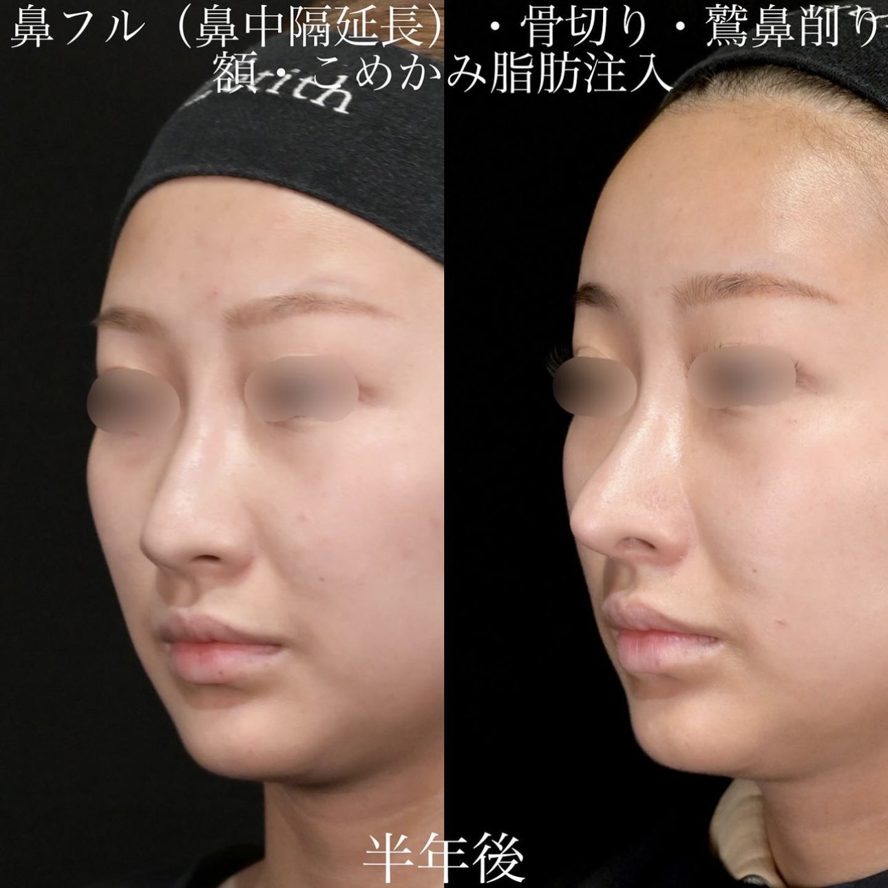 上木原医師による鼻整形の施術前／施術後6ヶ月 施術後 