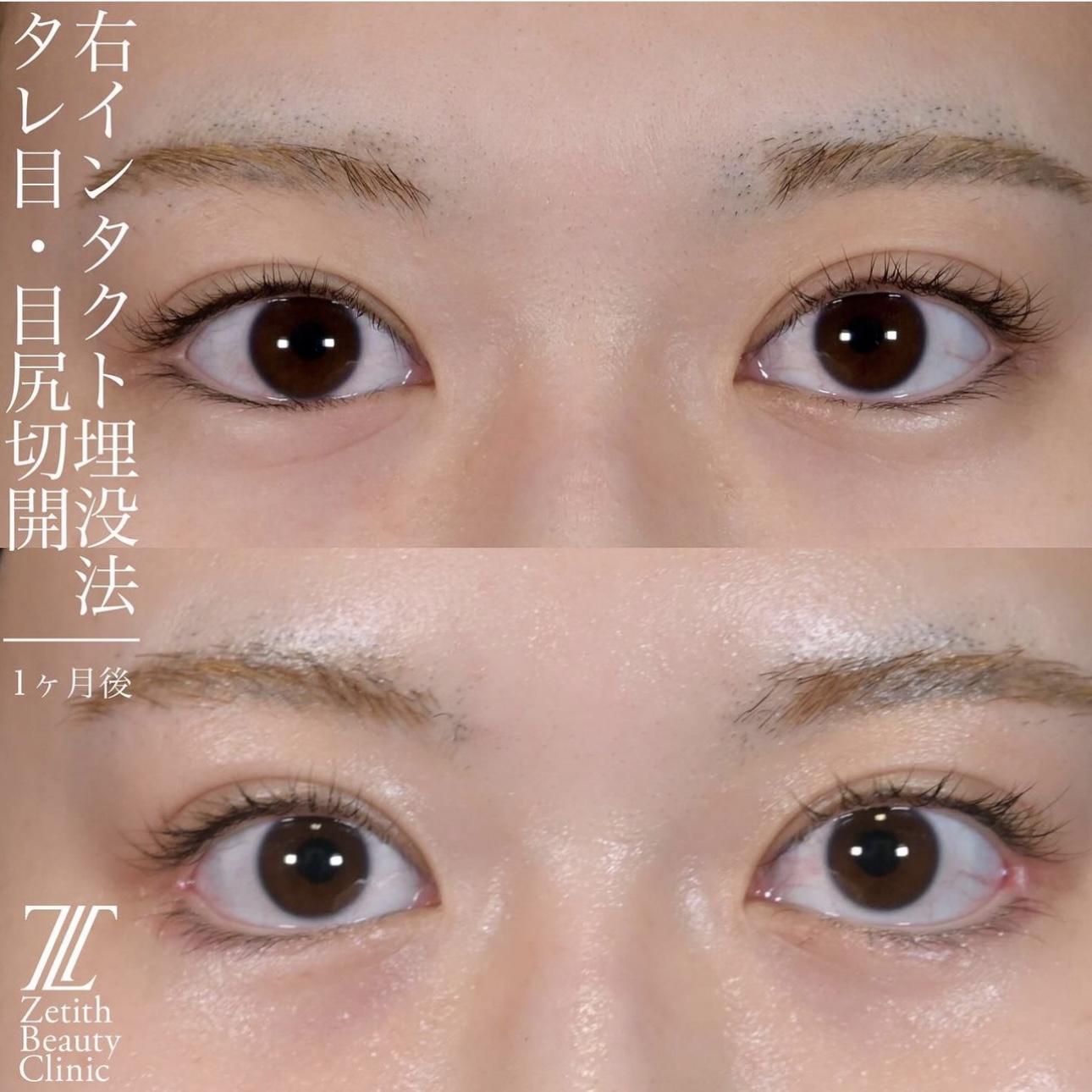 上木原医師による目元整形の施術前／施術後6ヶ月