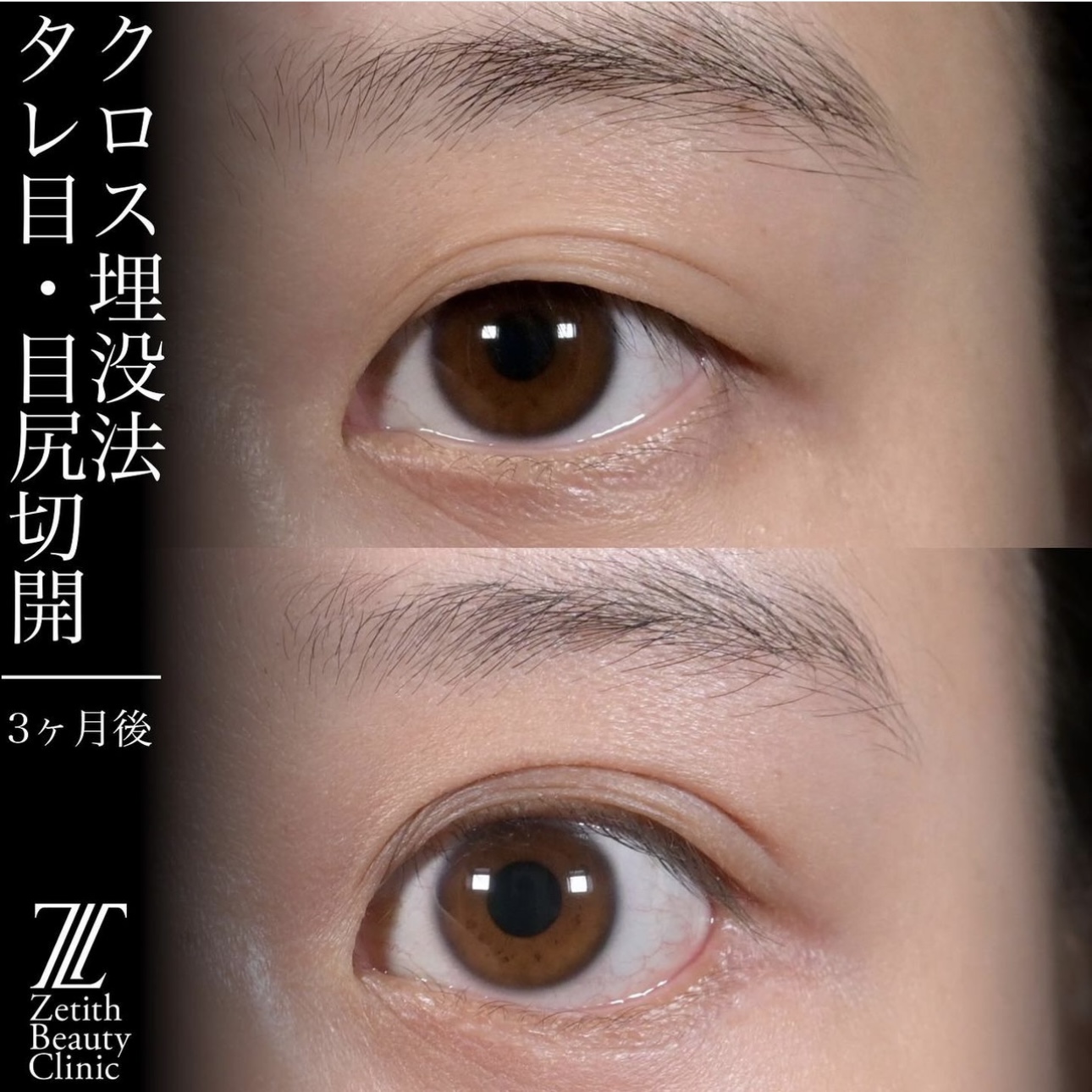 上木原医師による目元整形の施術前／施術後3ヶ月 After 