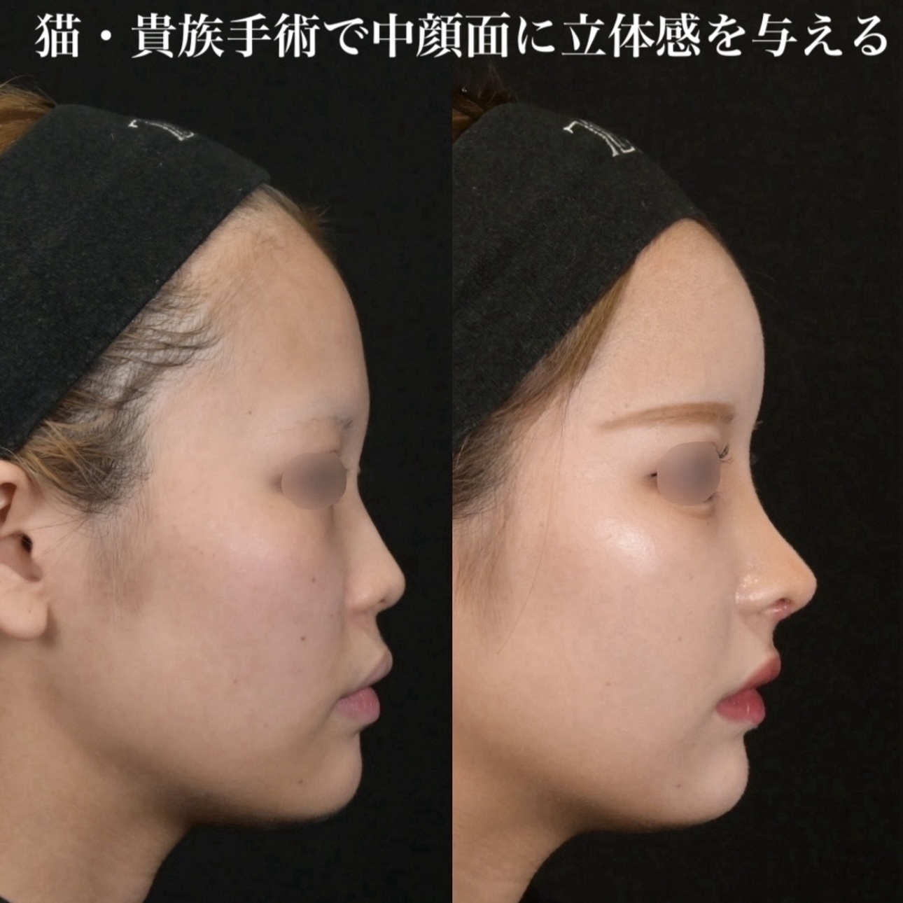 鉄医師による鼻整形の施術前／施術後1ヶ月