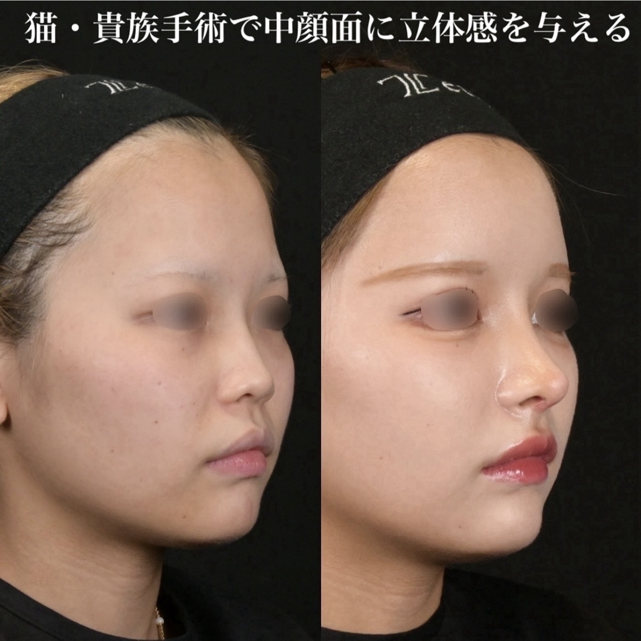 鉄医師による鼻整形の施術前／施術後1ヶ月 术后 