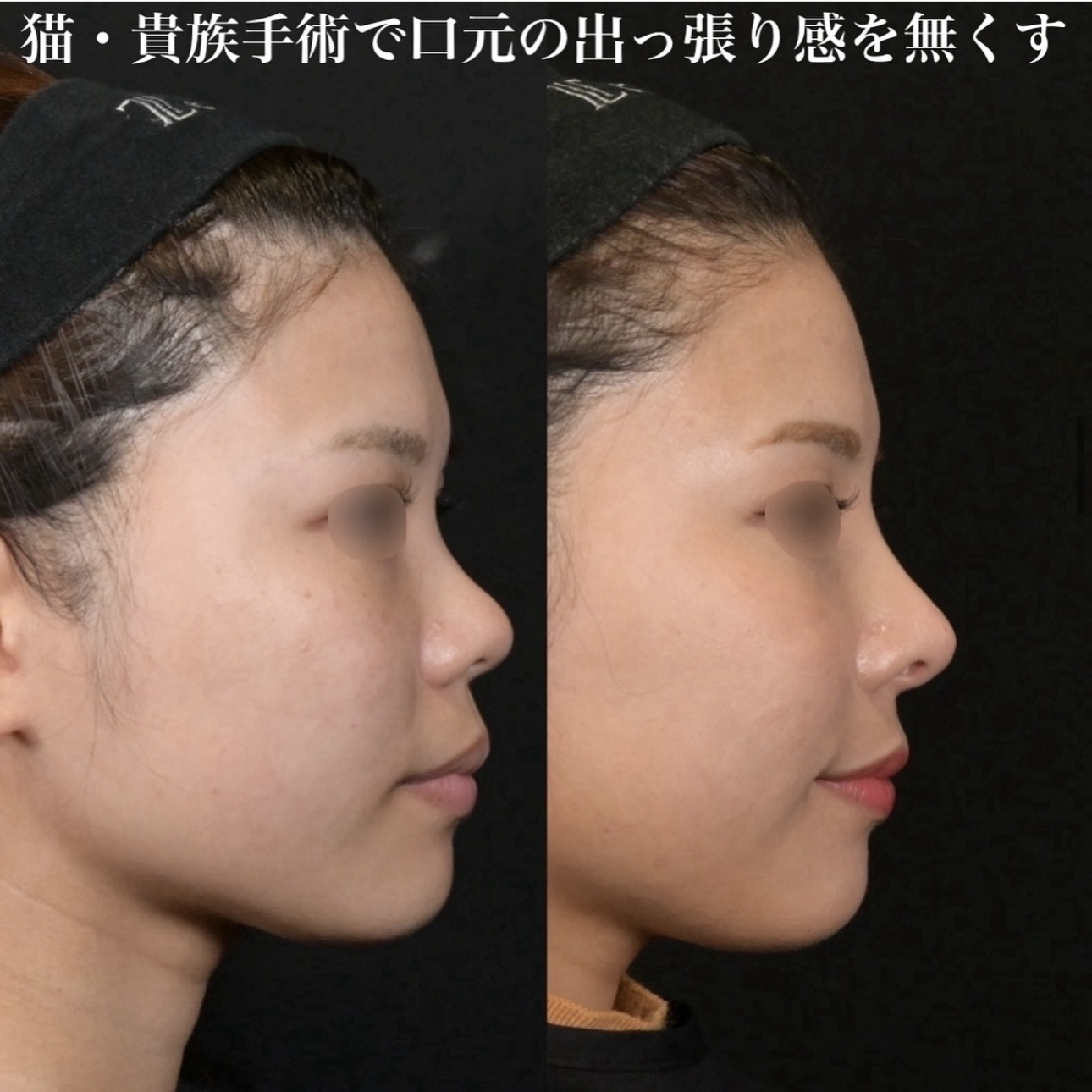 鉄医師による鼻整形の施術前／施術後6ヶ月