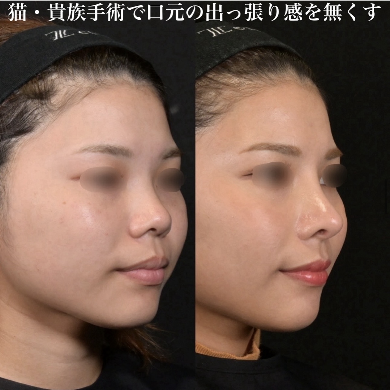 鉄医師による鼻整形の施術前／施術後6ヶ月 Дараа 