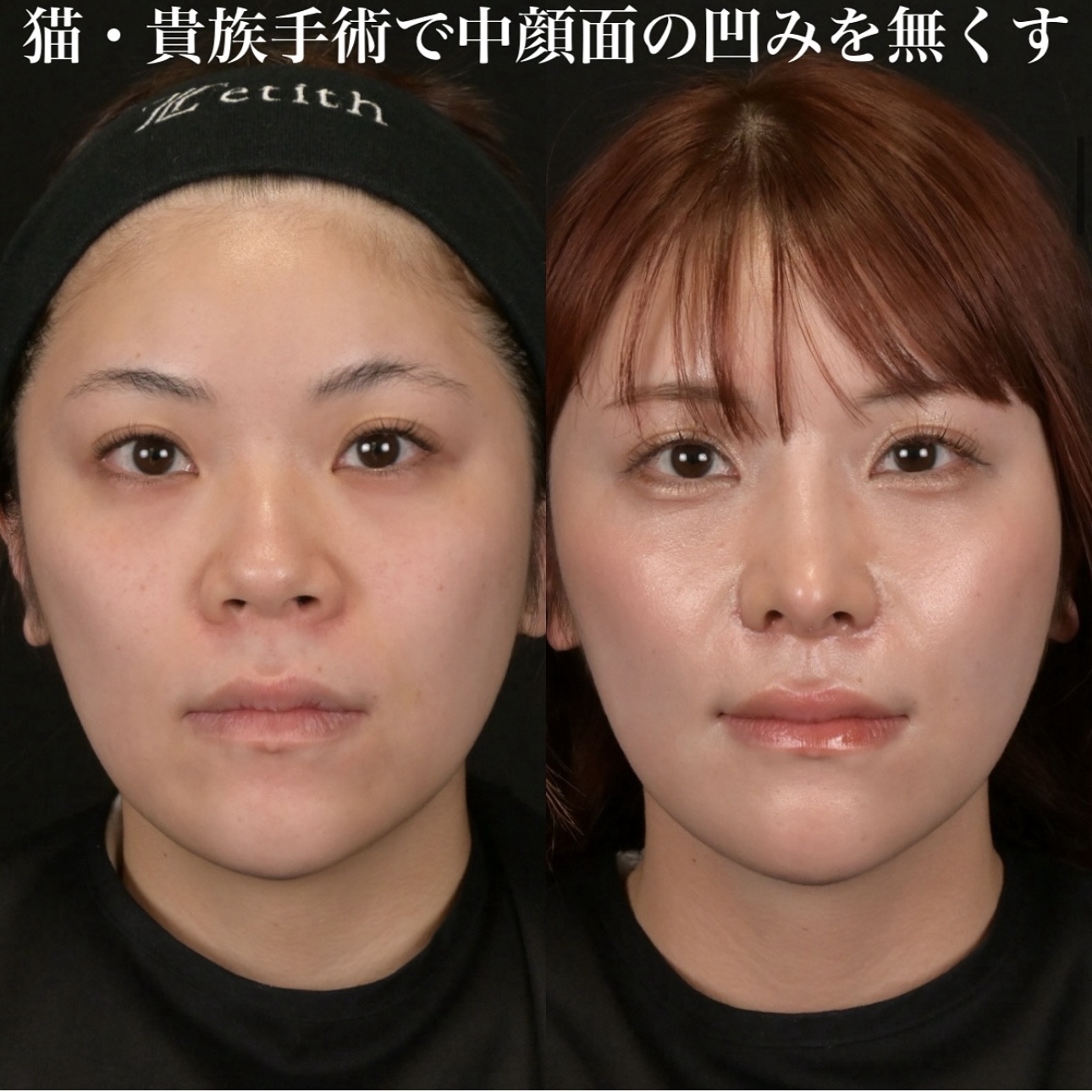 鉄医師による鼻整形の施術前／施術後1ヶ月