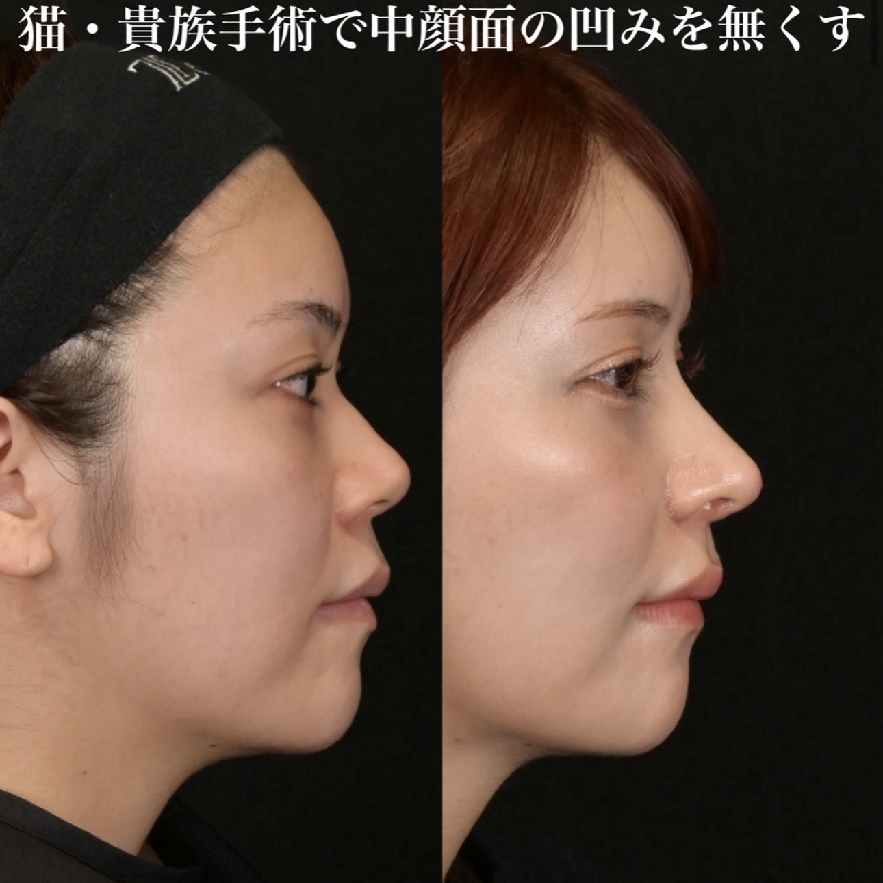 鉄医師による鼻整形の施術前／施術後1ヶ月 หลัง 