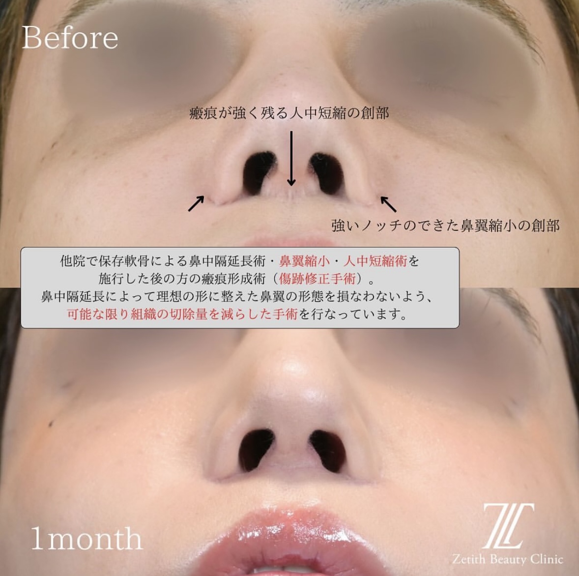 林医師による鼻整形の術前/術後1ヶ月