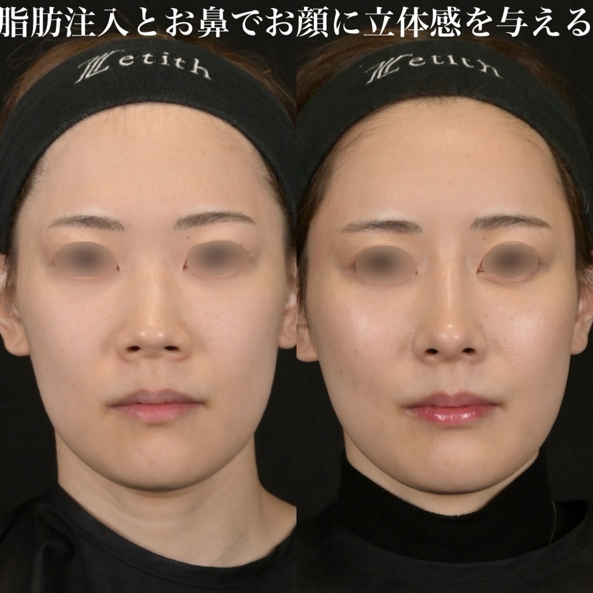 症例写真