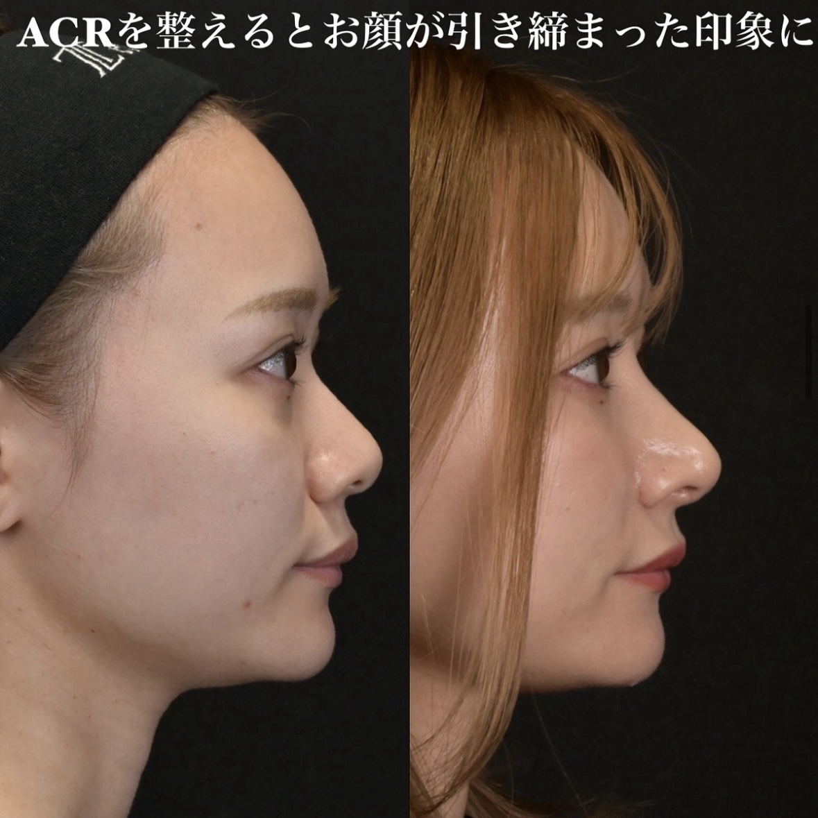 鉄医師による鼻整形の術前/術後3ヶ月 施術後 