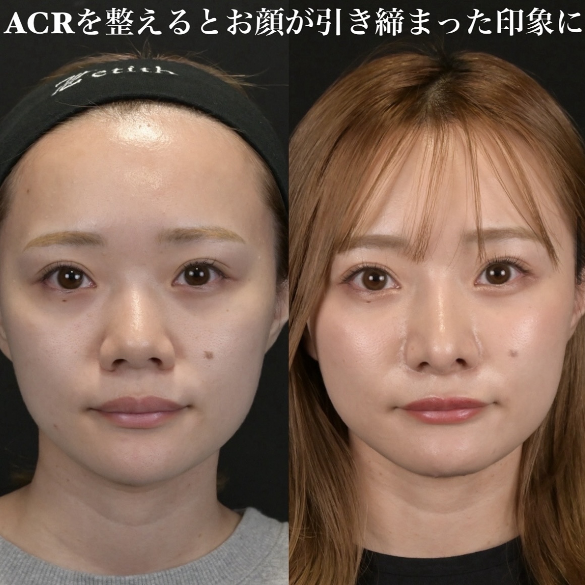 鉄医師による鼻整形の術前/術後3ヶ月