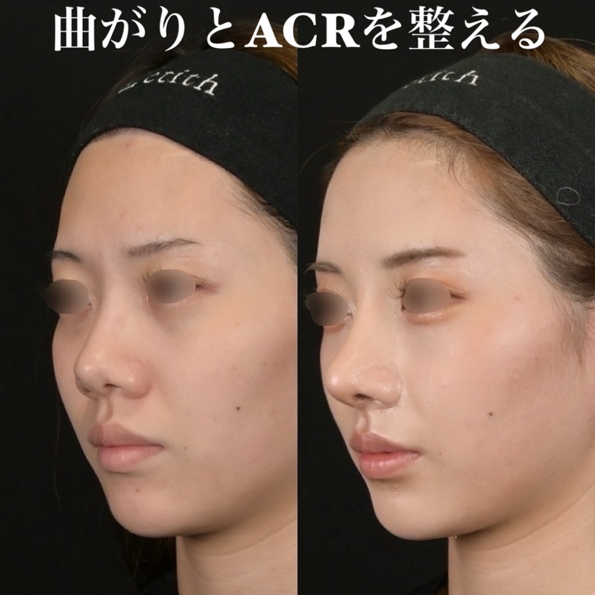 鉄医師による鼻整形の術前/術後1ヶ月 术后 