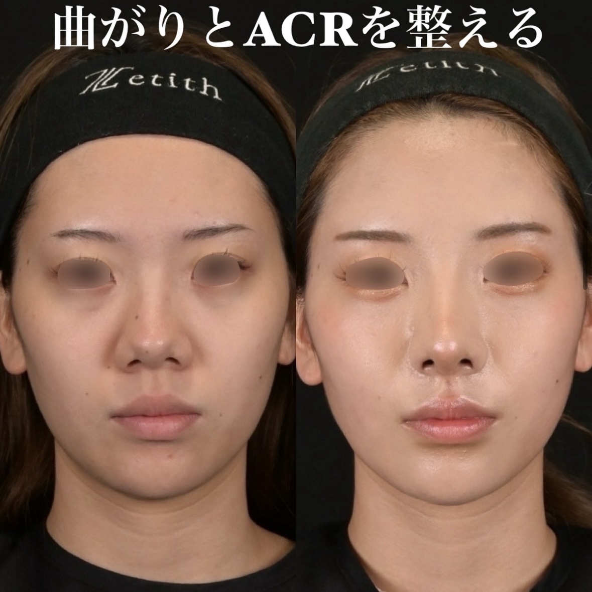 鉄医師による鼻整形の術前/術後1ヶ月