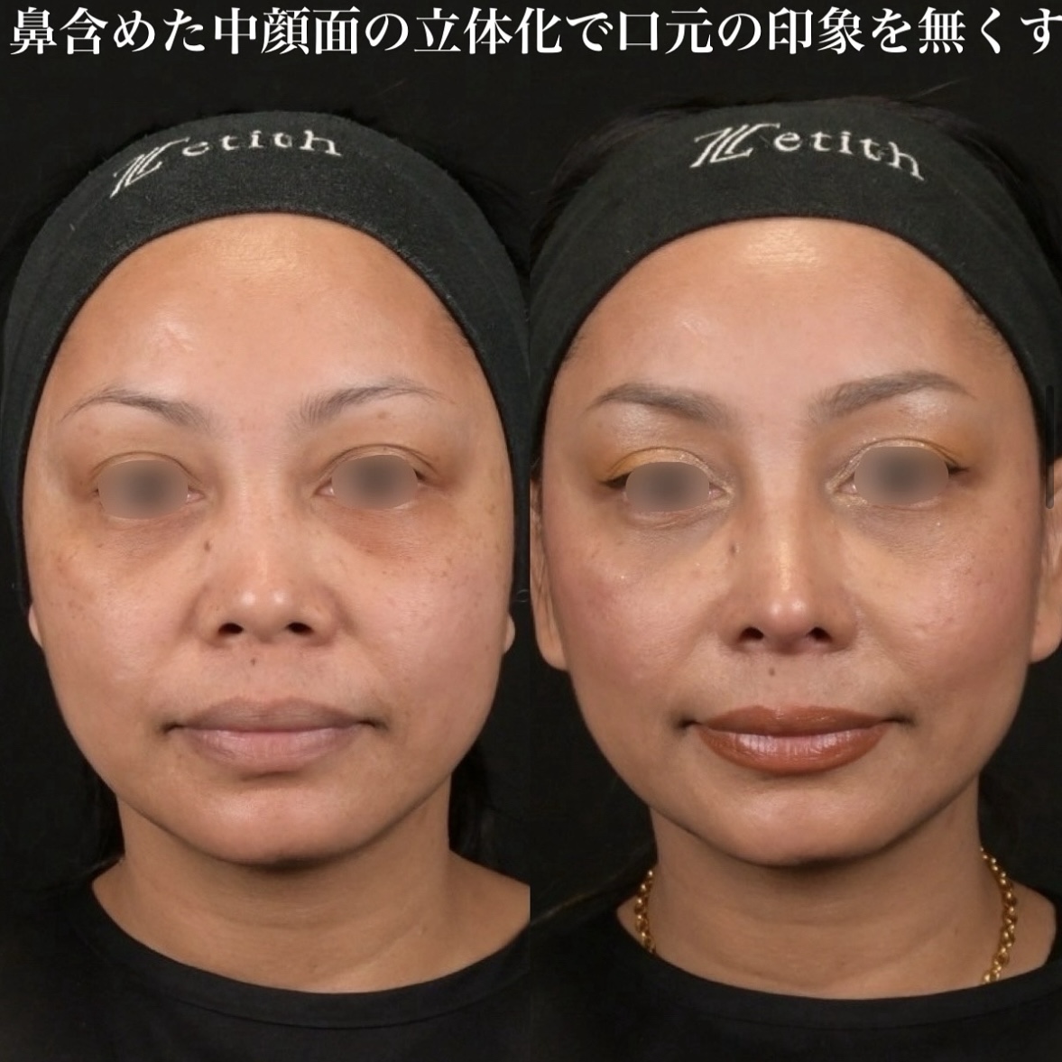 鉄医師による鼻整形の術前/術後1ヶ月