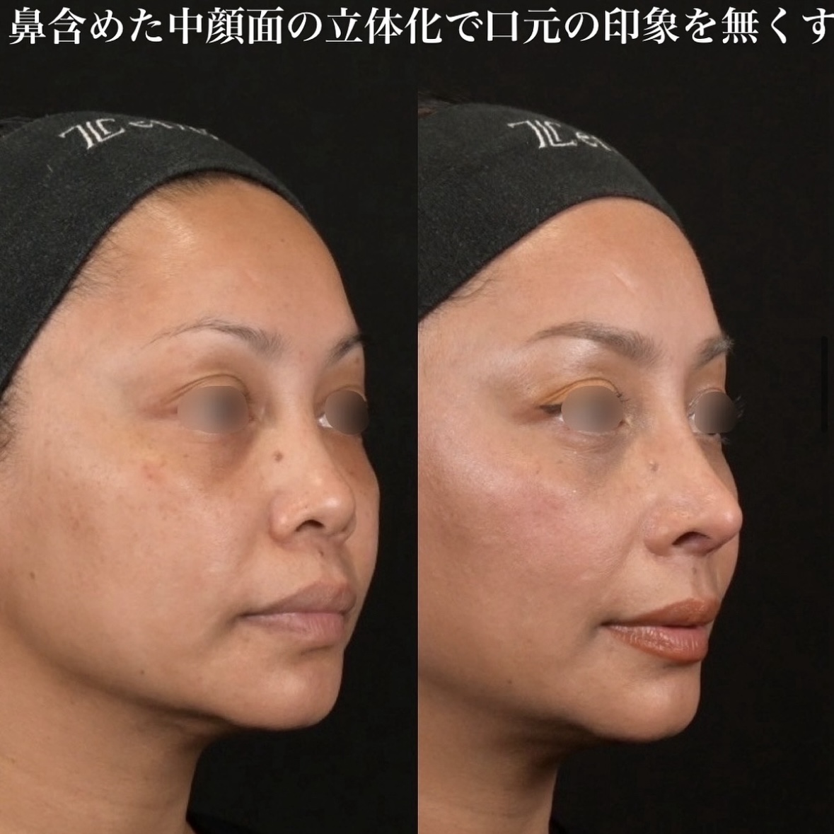 鉄医師による鼻整形の術前/術後1ヶ月 术后 