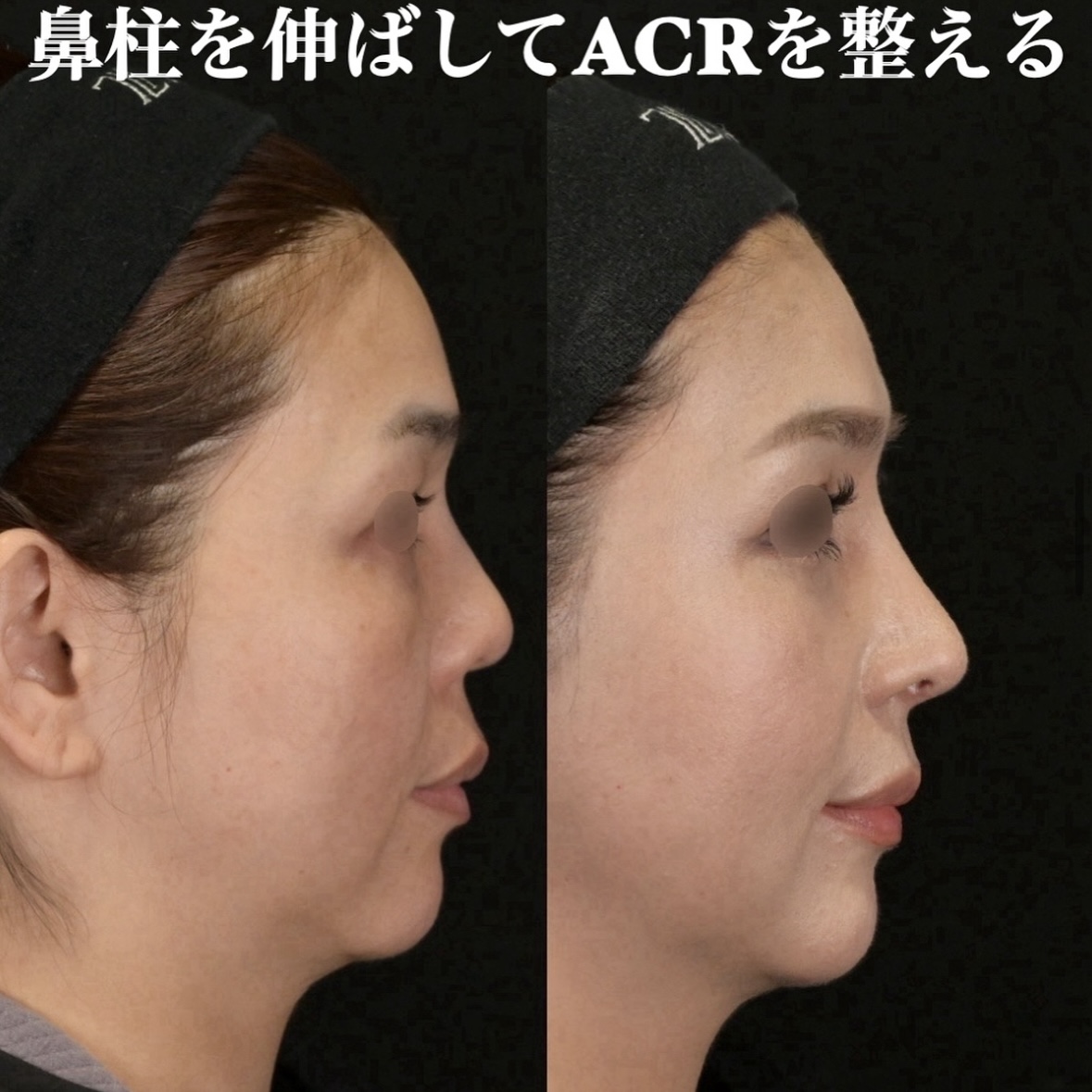 鉄医師による鼻整形の術前/術後1ヶ月