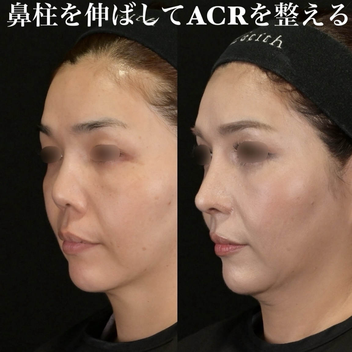 鉄医師による鼻整形の術前/術後1ヶ月 施術後 