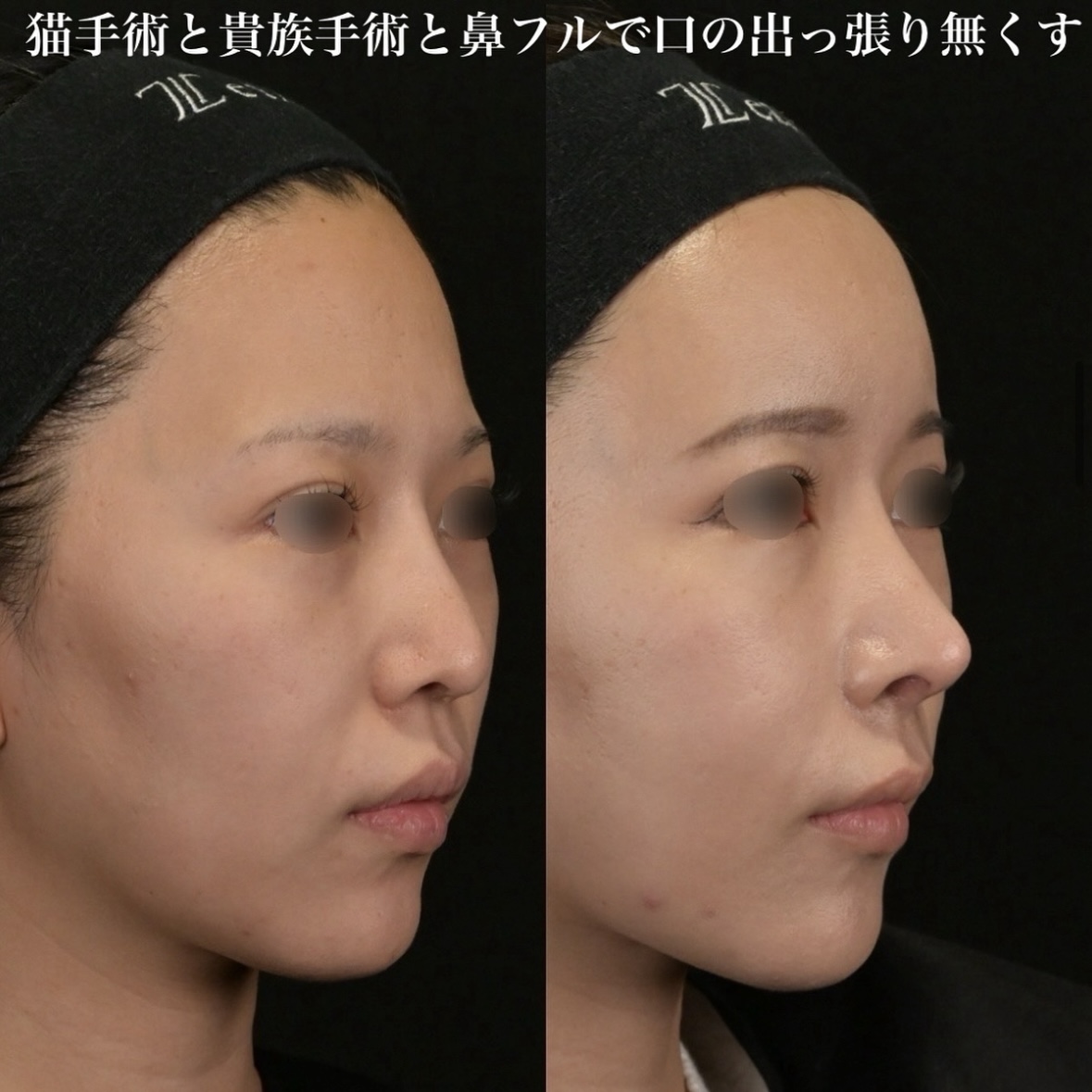 鉄医師による鼻整形の術前/術後3ヶ月