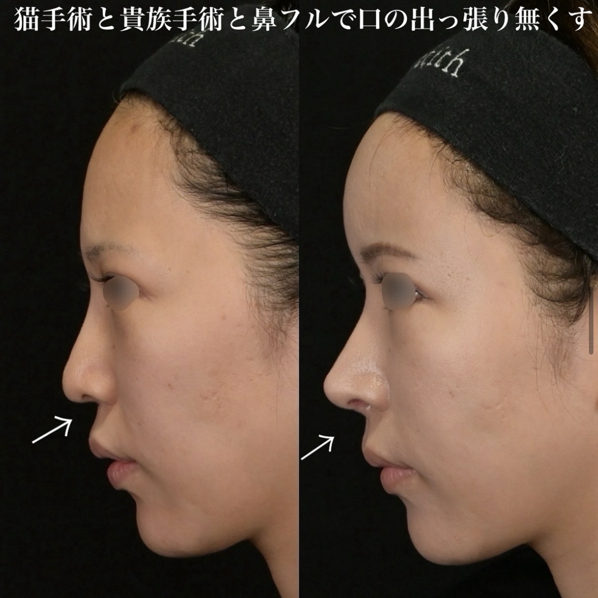 鉄医師による鼻整形の術前/術後3ヶ月 After 