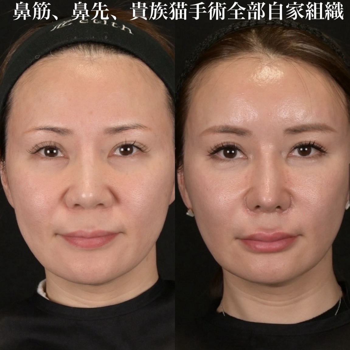 鉄医師による鼻整形の術前/術後2週間