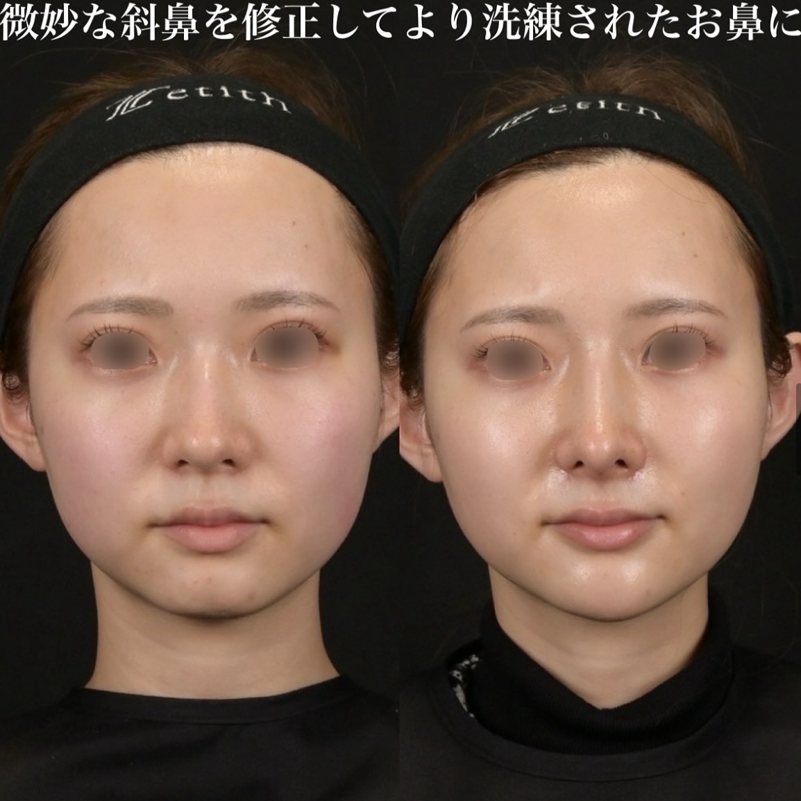 鉄医師による鼻整形の術前/術後1ヶ月