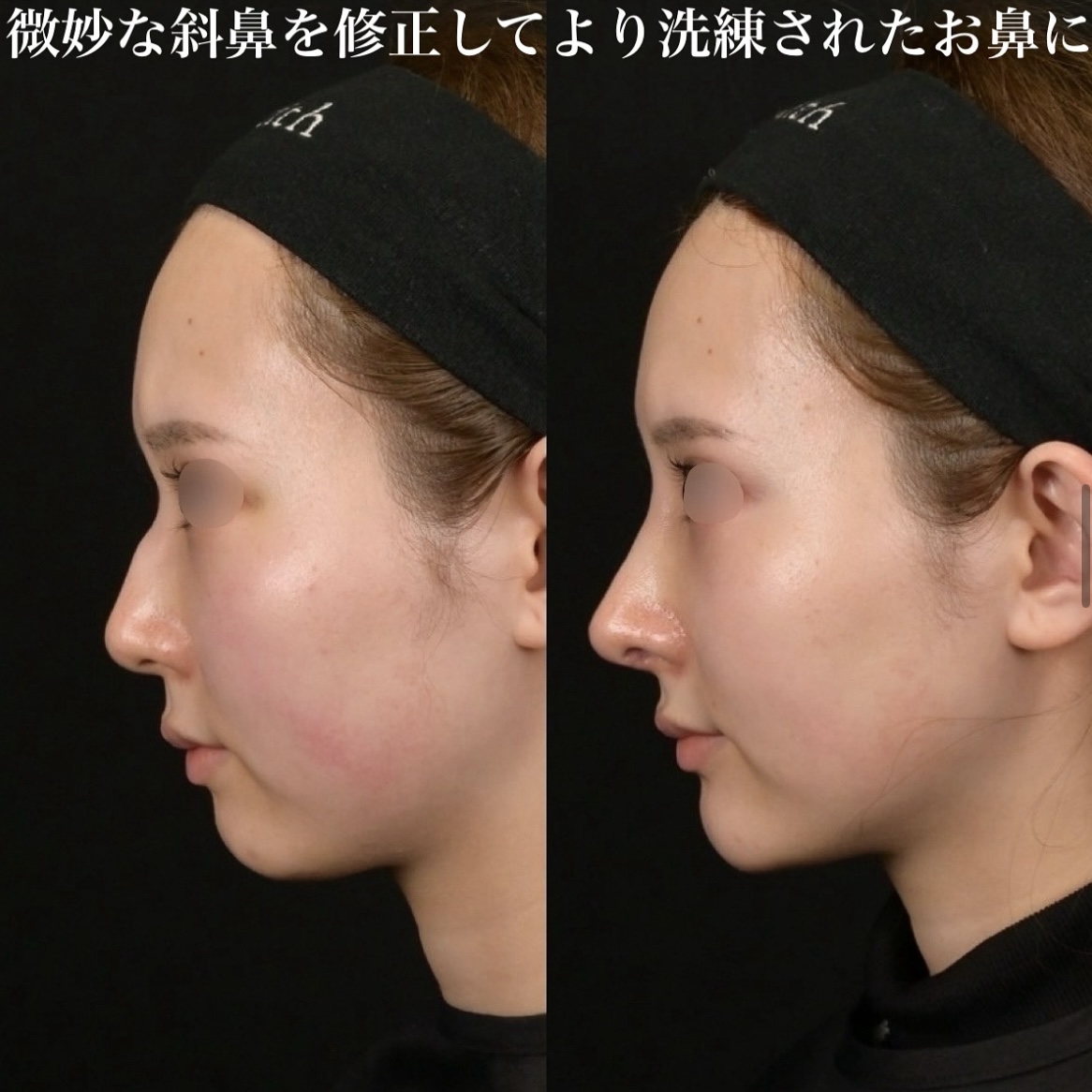 鉄医師による鼻整形の術前/術後1ヶ月 หลัง 