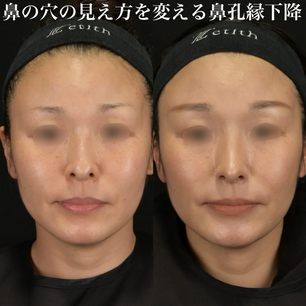 鉄医師による鼻整形の術前/術後3ヶ月