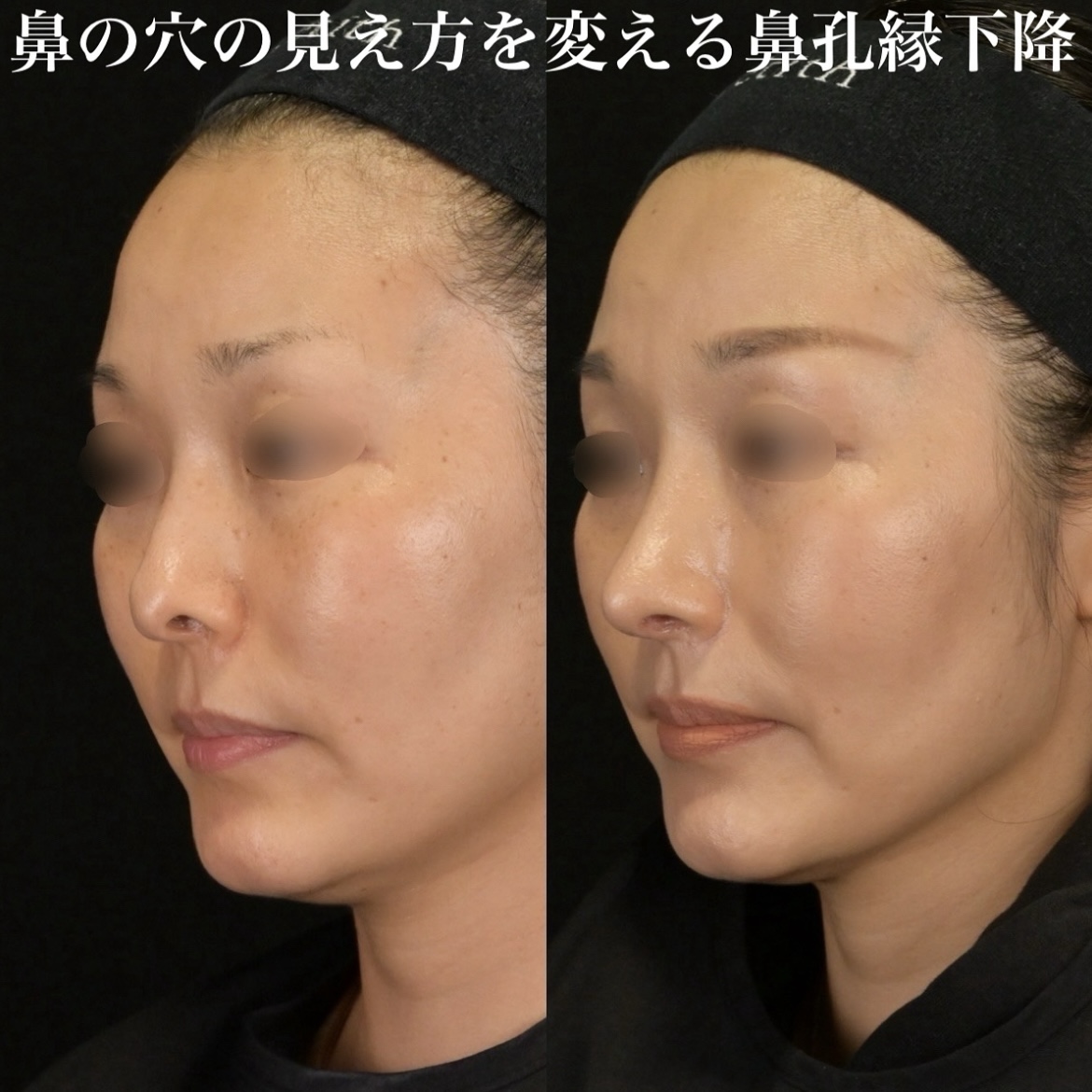 鉄医師による鼻整形の術前/術後3ヶ月 Дараа 