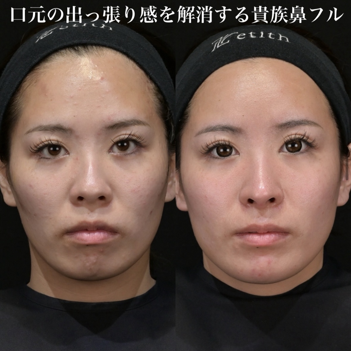 鉄医師による鼻整形の術前/術後5ヶ月