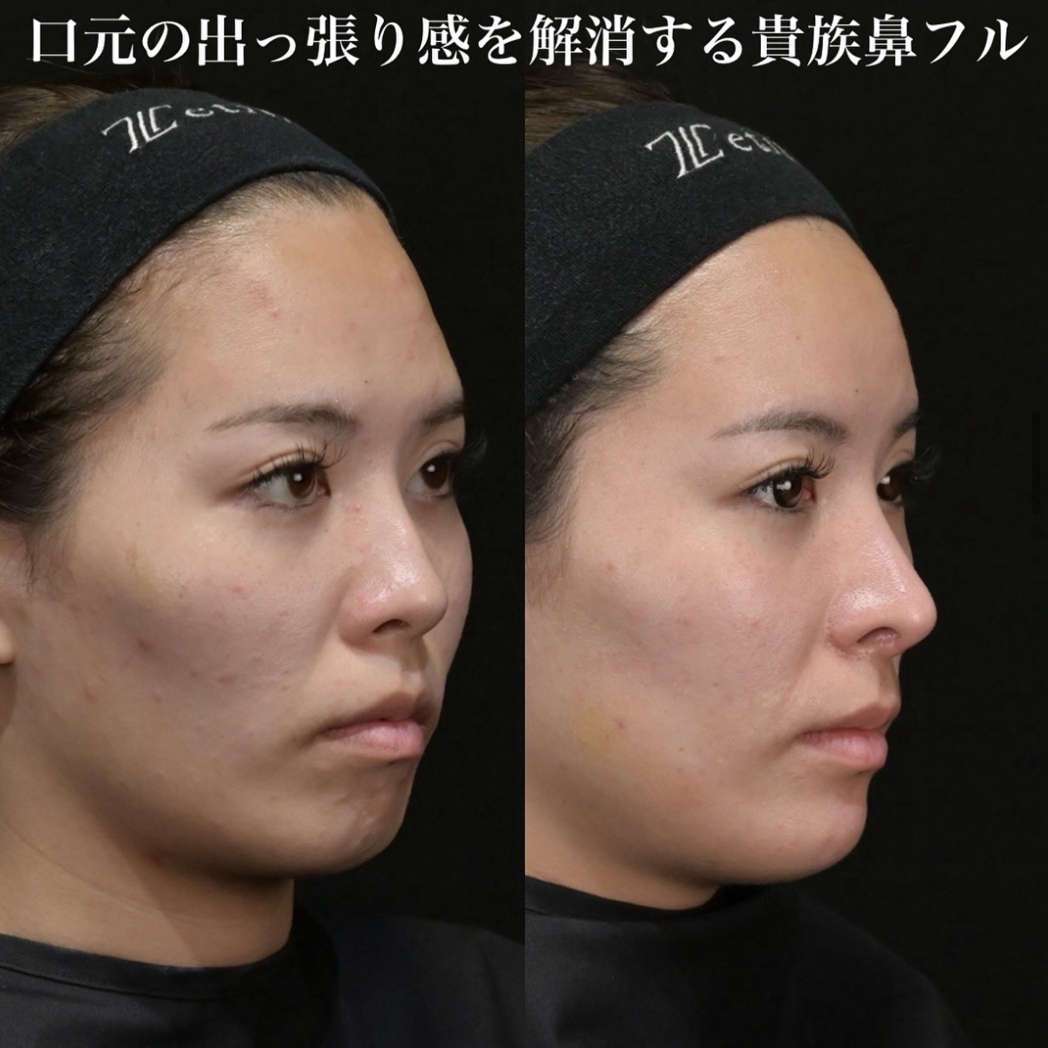 鉄医師による鼻整形の術前/術後5ヶ月 หลัง 