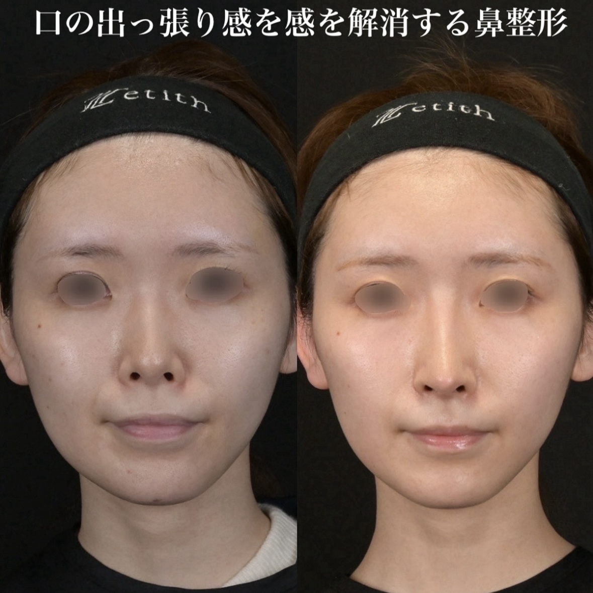 鉄医師による鼻整形の術前/術後3ヶ月