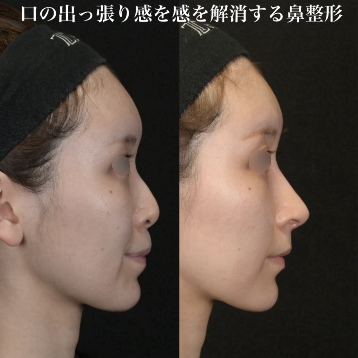 鉄医師による鼻整形の術前/術後3ヶ月 施術後 