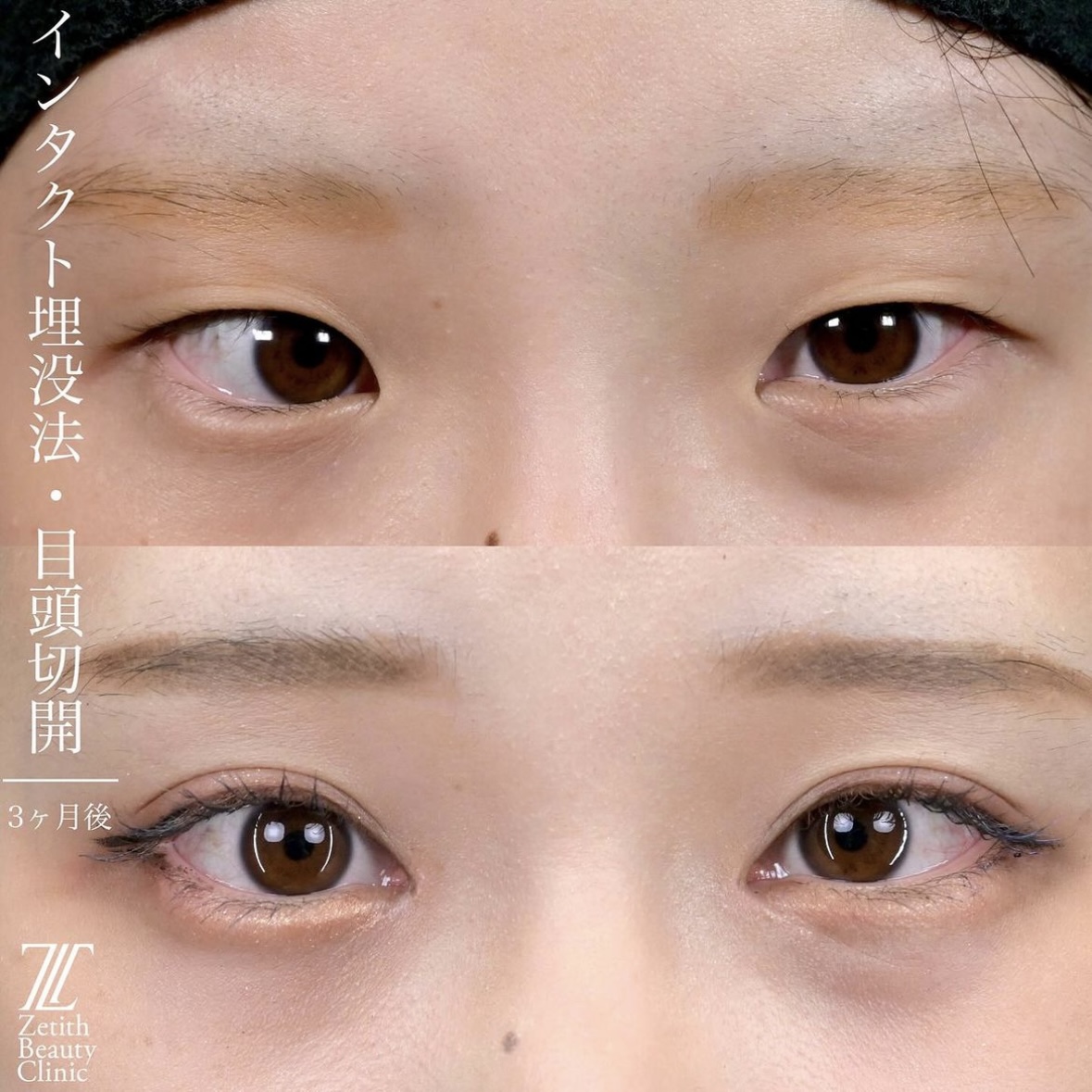 上木原医師による目元整形の術前/術後3ヶ月後